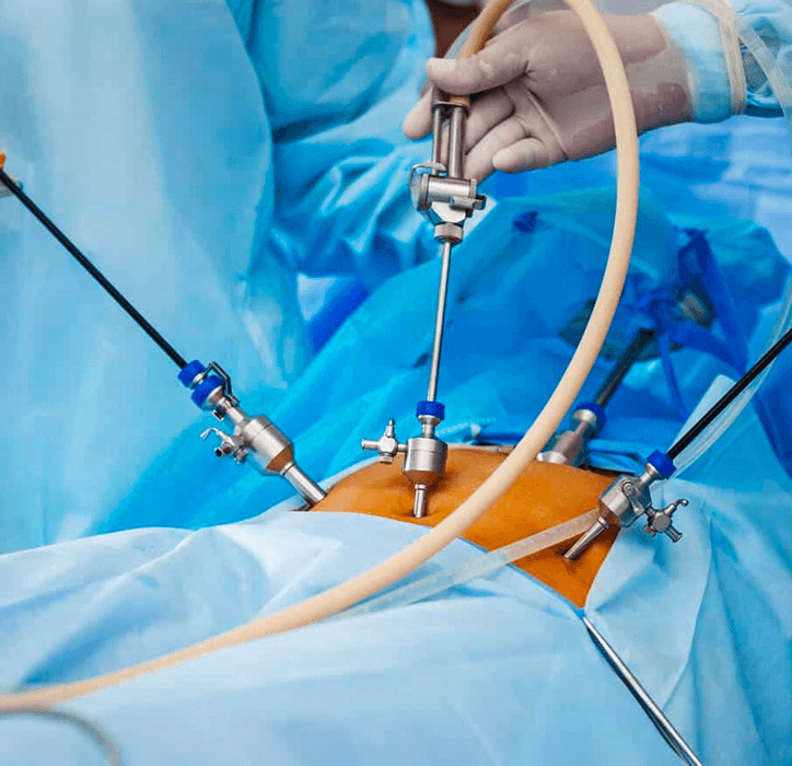 Apendicectomía laparoscópica